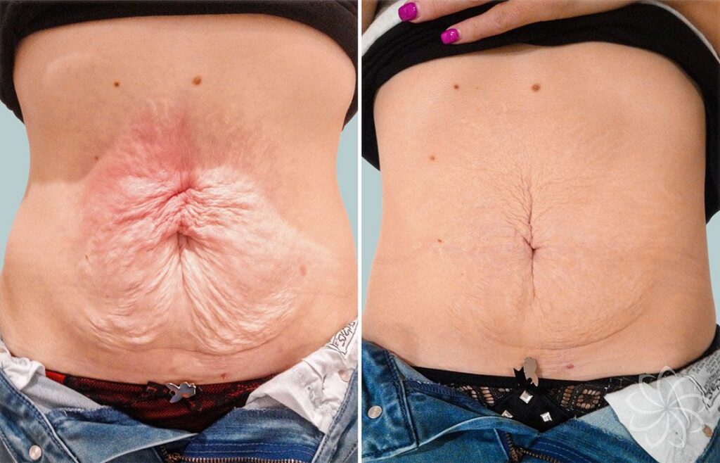 How to tighten loose, saggy skin after weight loss