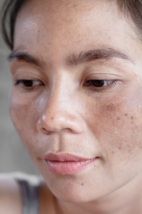 Sunspot Melasma Skin Pigmentation treatment on female face