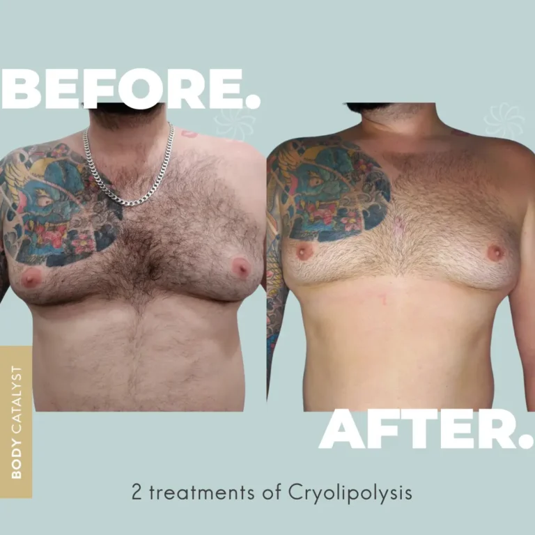 How to get rid of man boobs with cryo