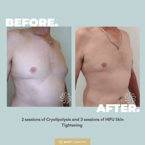 Man Boobs Post Cryo & HIFU skin tightening sessions