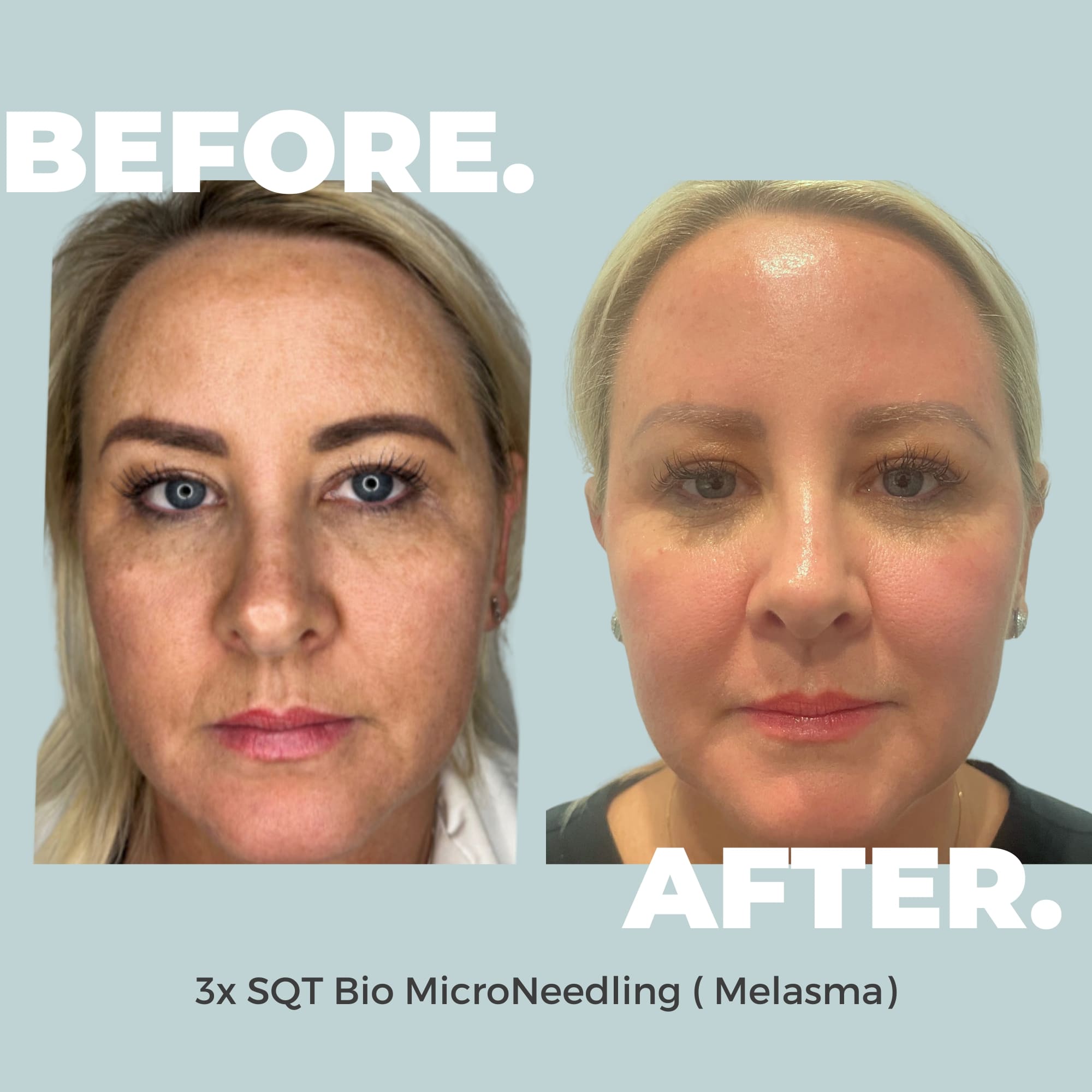 Melasma Before & After Bio-microneedling